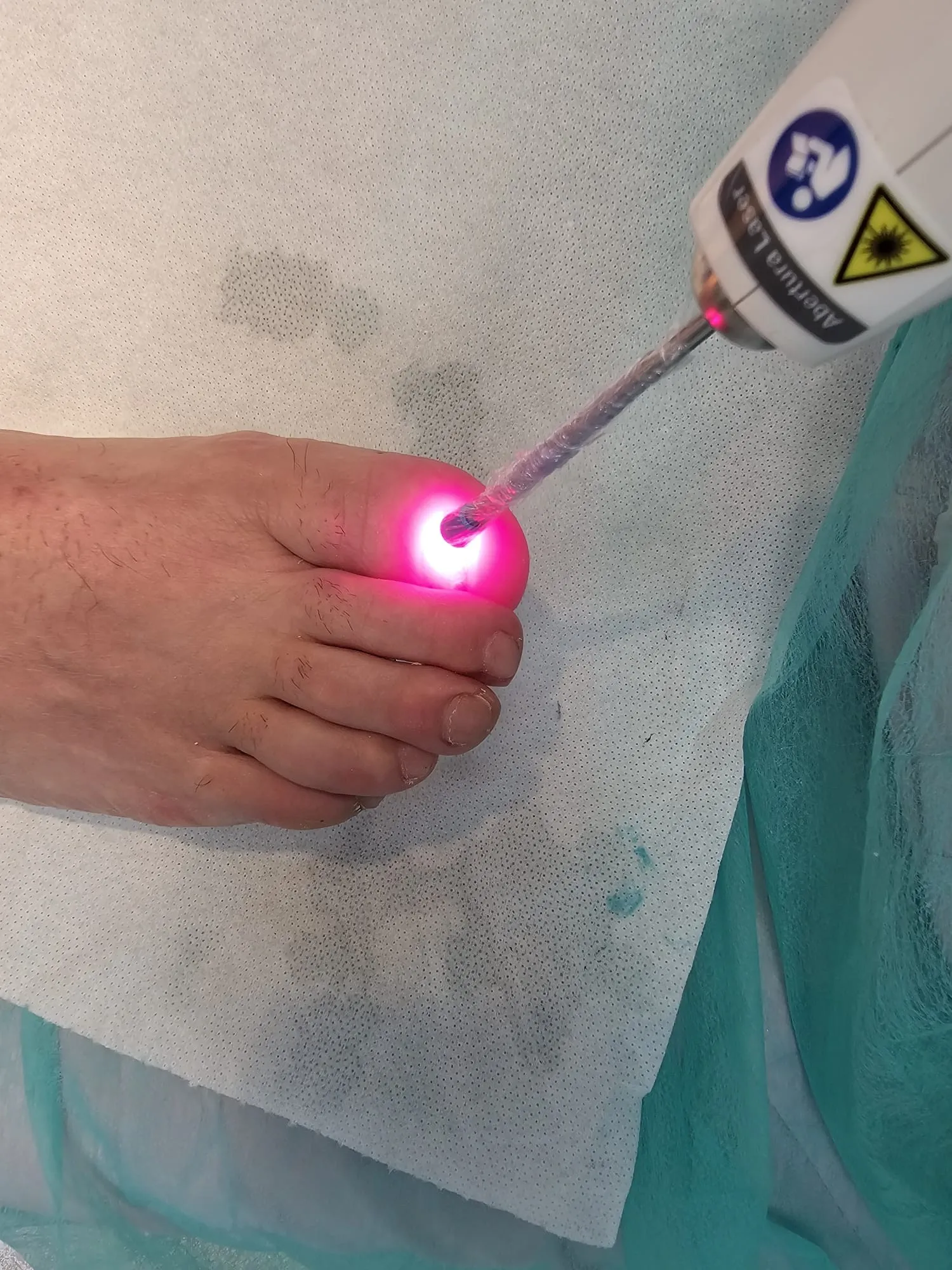 Ponteira do laser aplicada sobre a unha do dedo grande