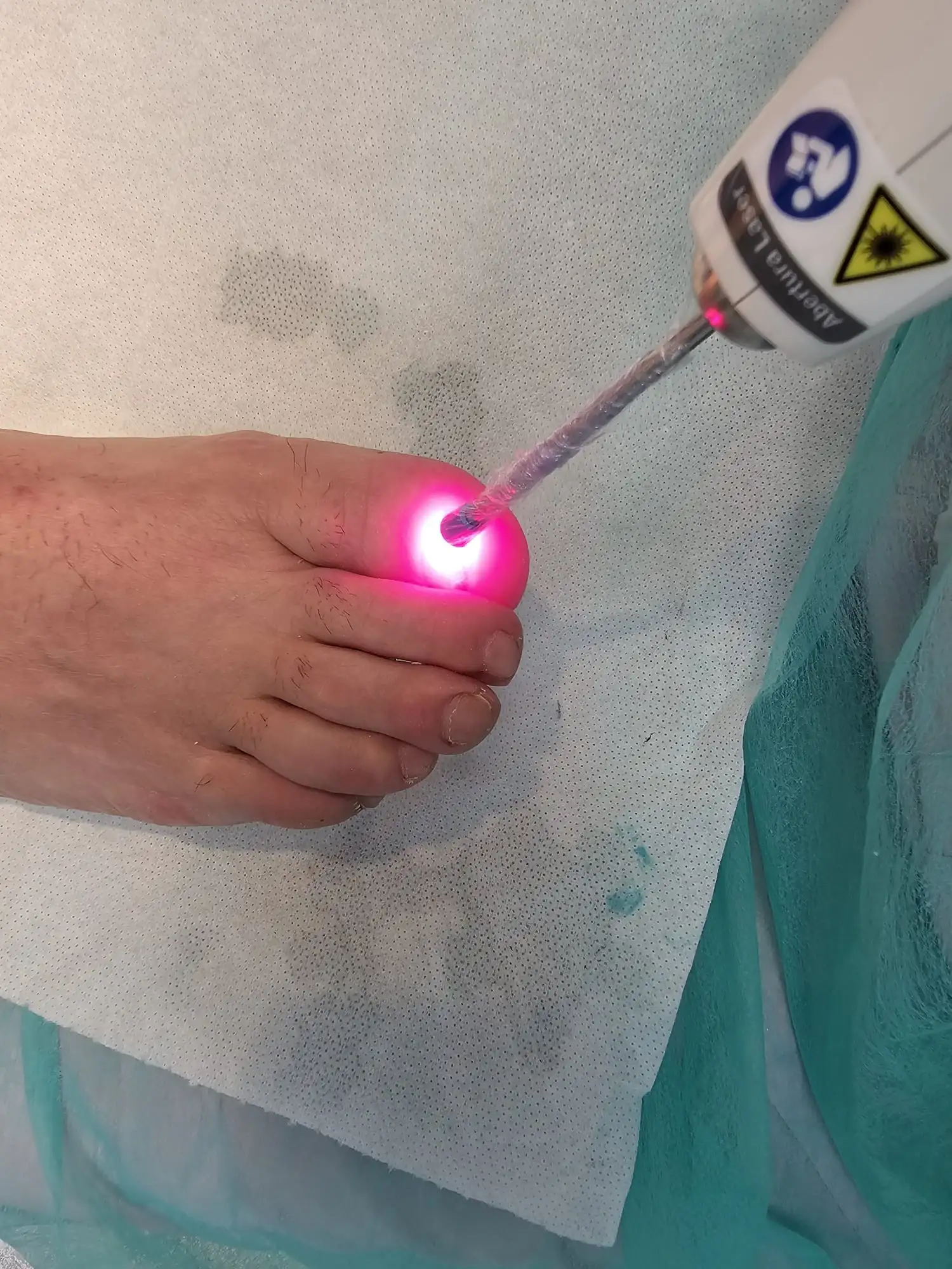 Laser aplicado sobre a unha do dedo grande do pé, durante o tratamento