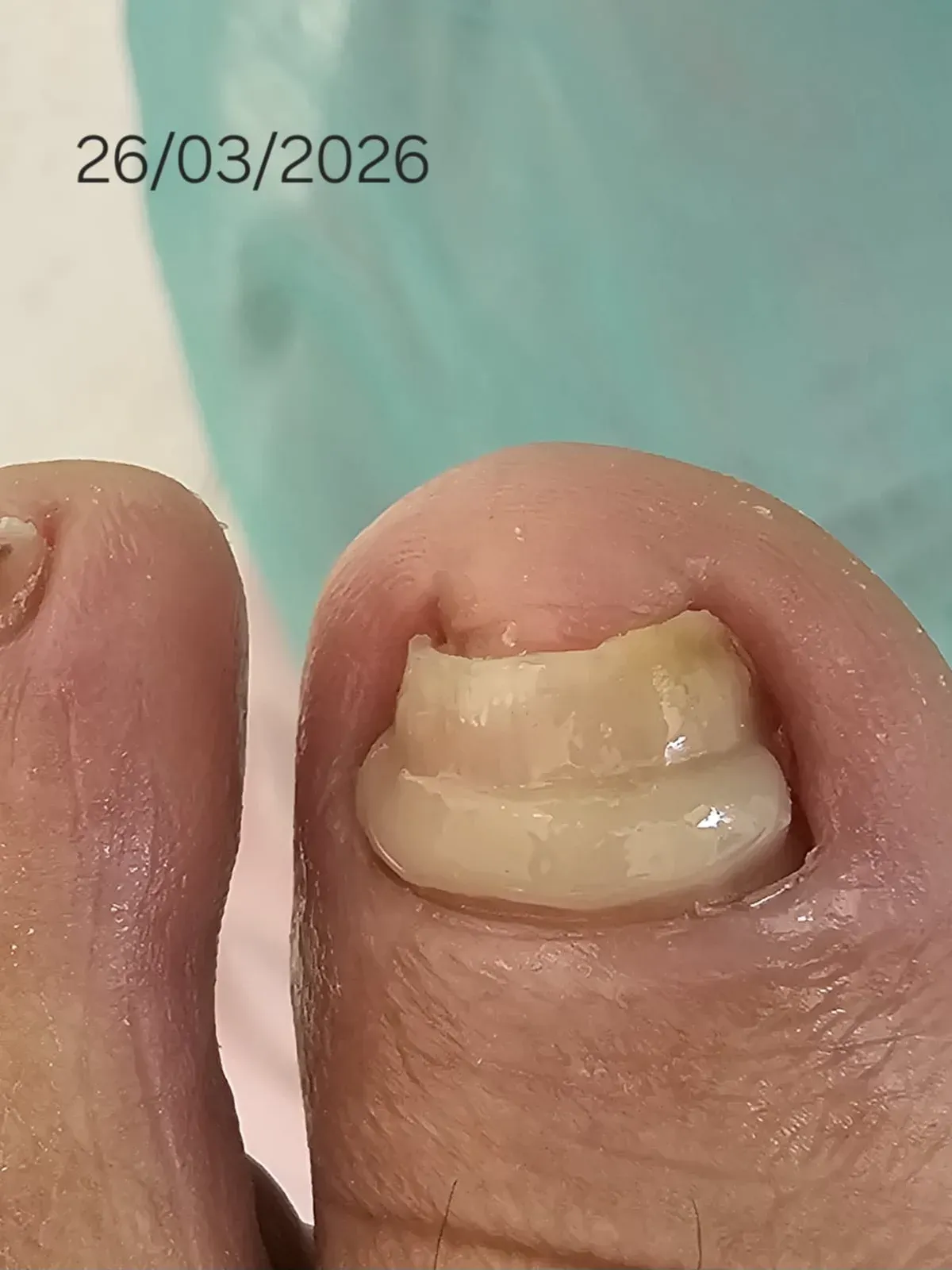 Órtese aplicada sobre a unha do dedo grande