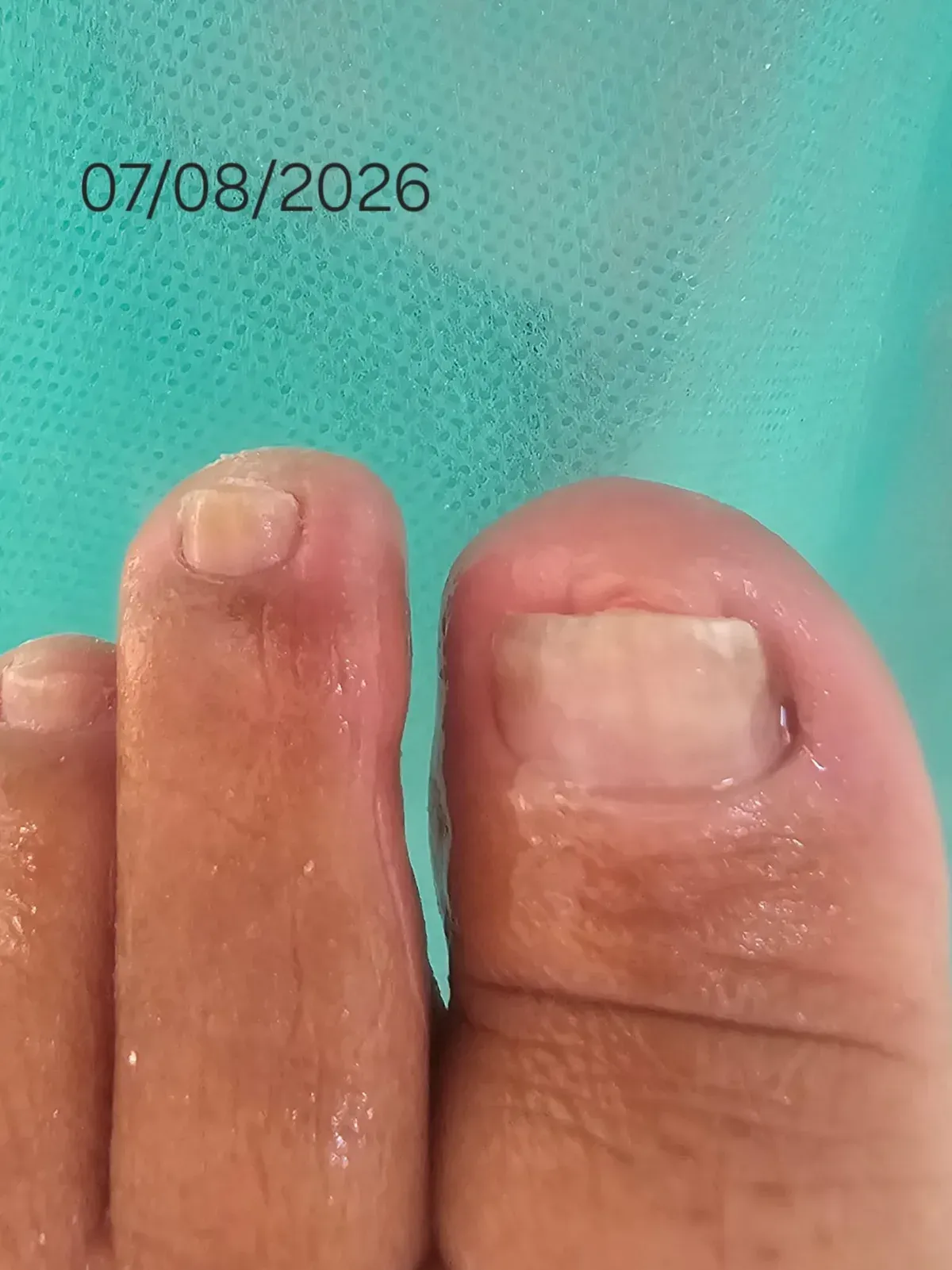 Unha do dedo grande com a curvatura corrigida