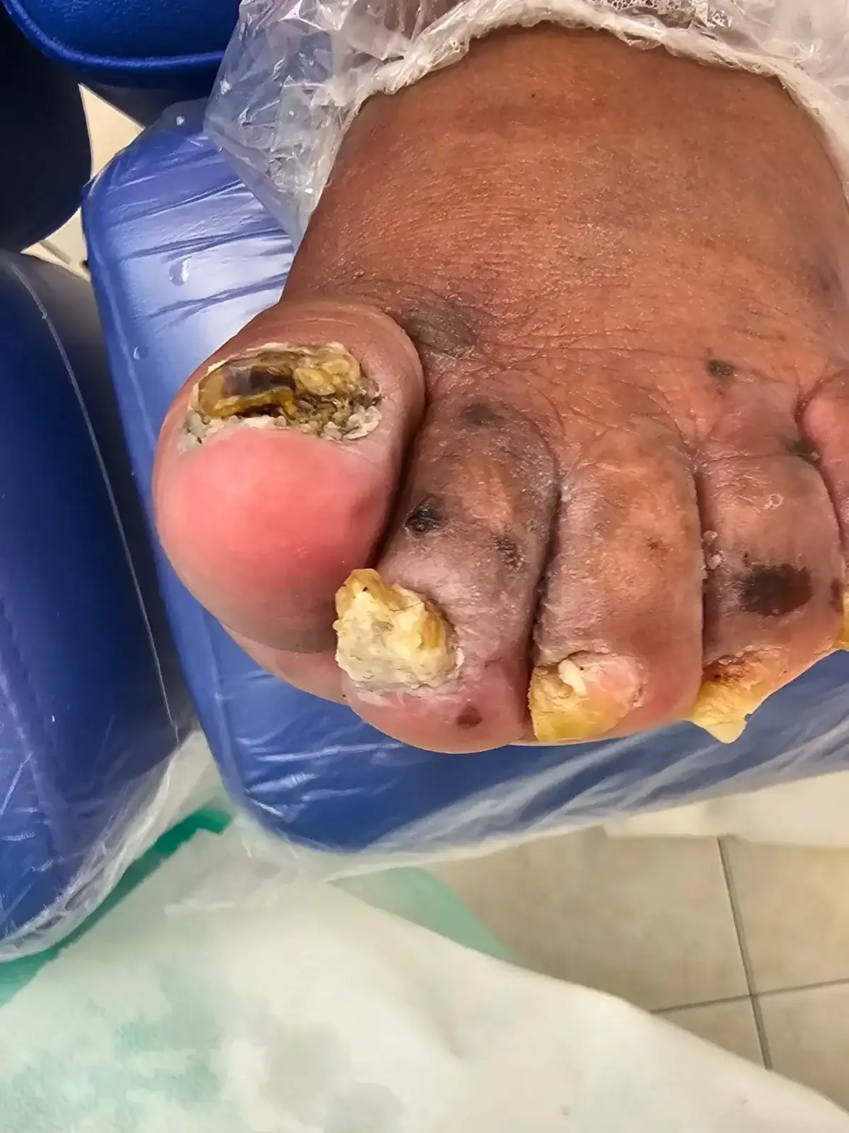 Unhas dos pés muito espessadas e deformadas
